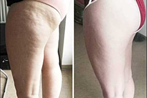 My Cellulite Solution Review