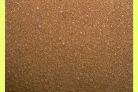A Photo Guide To 20 Types Of Skin Bumps You Might Find On Your Body